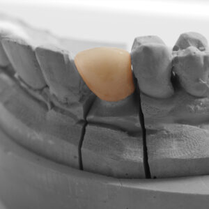 https://www.sivpdental.es/wp-content/uploads/2023/03/Couronne-ceramo-metallique-300x300.jpeg