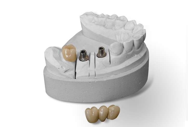 https://www.sivpdental.es/wp-content/uploads/2023/04/PROTHESES-SUR-IMPLANT.png