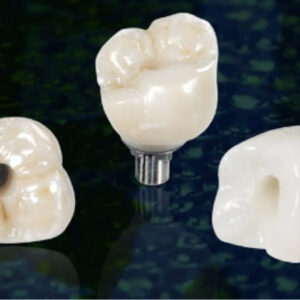 https://www.sivpdental.es/wp-content/uploads/2023/05/Couronne-transvissee-sur-implant-300x300.jpg